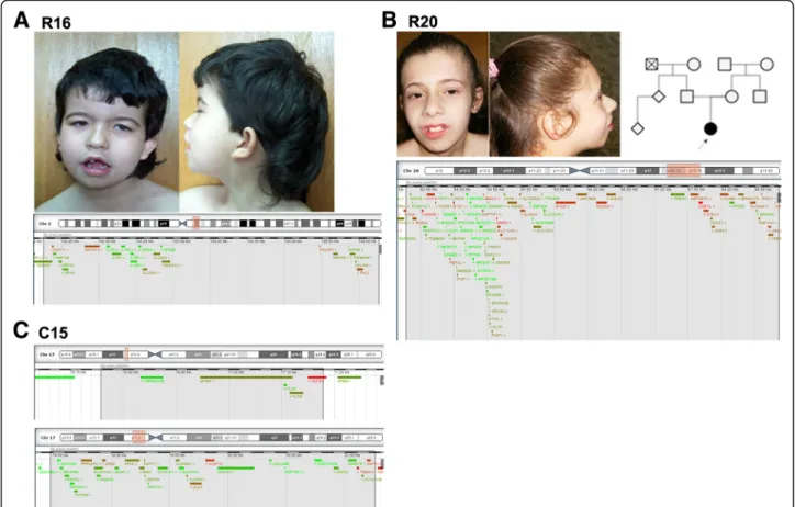 Fig. 1 Facial appearance of patients and schematic representation of the deletions. a Patient R16 facies, with low set posteriorly rotated ears, anteverted ears with simplified helix, temporal narrowing with prominent metopic suture, arched eyebrows, synop