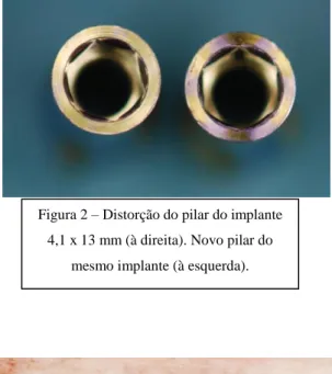 Figura  1 – Fratura do pilar do implante  3,3 x 13 mm