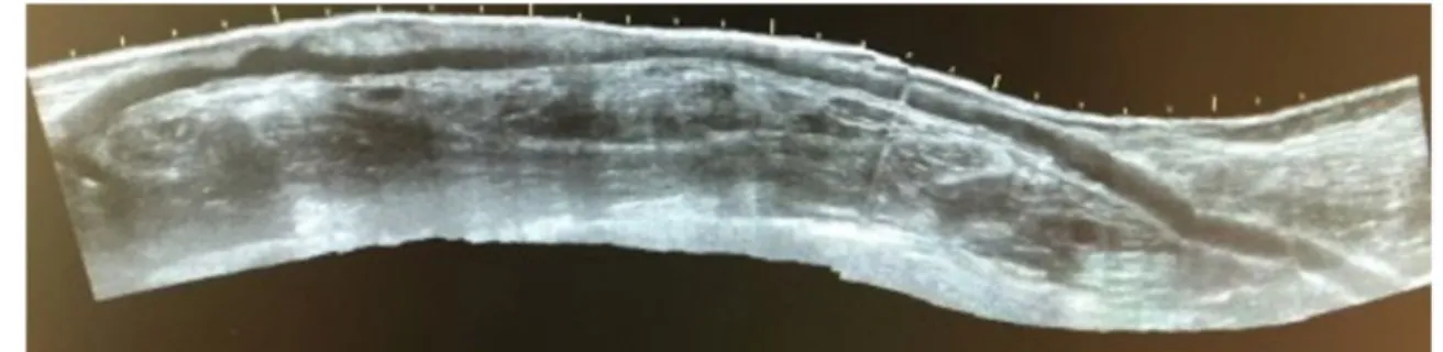 Figure 4 Post implantation of the Early cannulation Graft.
