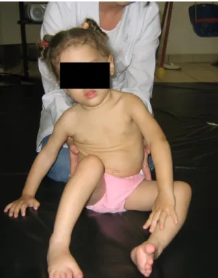 Figura  8:  Criança  portadora  de  PC  tipo  diplegia  espástica  sentada  com  retroversão  pélvica  dificultando  a  postura sentada sem apoio