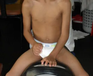 Figura 9. Criança portadora de PC do tipo diplegia espástica em abdução de quadril montada no simulador