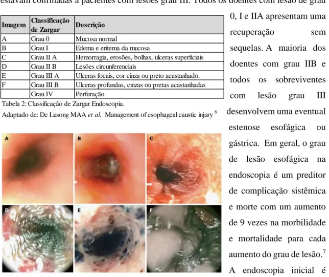 Tabela 2: Classificação de Zargar Endoscopia. 