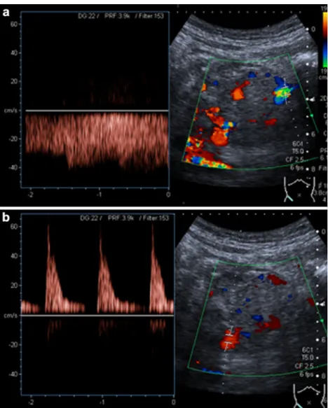 Fig. 3 MPR coronal oblique contrast-enhanced MDCT images showing a normal pancreatic graft arterial supply after SPK transplantation