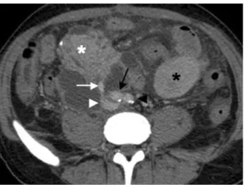 Fig. 6 Coronal reformatted MDCT image shows homogeneous en- en-hancement of the pancreatic (white asterisk) and renal grafts (black asterisk) after SPK transplantation