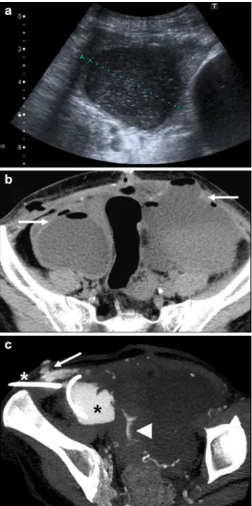 Fig. 14 A 37-year-old woman with peritonitis 5 weeks after SPK transplantation. Contrast-enhanced MDCT shows fluid collections surrounded by enhanced peritoneum (arrows)