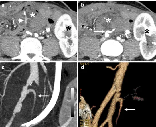 Fig. 18 A 44-year-old woman after SPK transplantation. Contrast- Contrast-enhanced MDCT shows non-enhancement of the right common iliac vein compared with left side