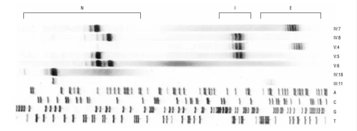 Figure 1. Analysis of (CAG) n length in a pedigree with Machado-Joseph disease (families MJD75 and MJD75b)