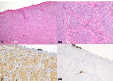 Figure 2. Histology and immunohistochemistry: (A) H&amp;E, 100x; 