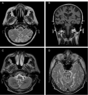 Figure 2. Axial T2-WI showing diffuse hyperintensity occurring in the pons (round overlay), suggestive of small vessel ischemic pathology.