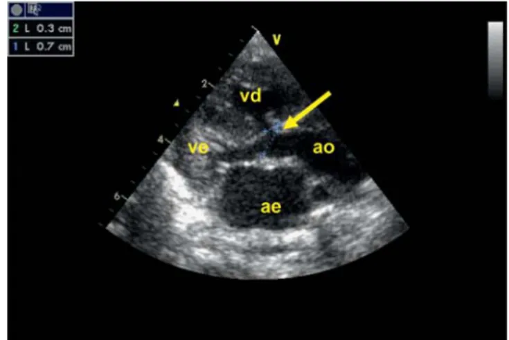 Figura 1 – Ecocardiograma, plano subcostal: A - Presença de comunicação entre parede da aorta ascendente e o tronco da artéria pulmonar (ve- ven- ven-trículo esquerdo, ao- aorta, ap- artéria pulmonar)