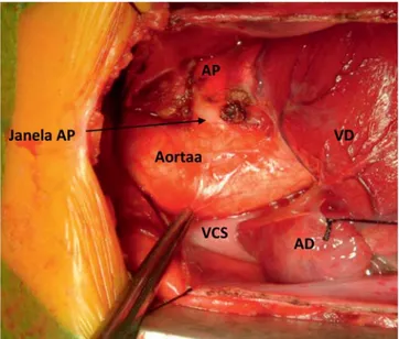 Figura 4 – Imagem cirurgia antes da entrada em circulação extra cor- cor-poral (AP- artéria pulmonar, VD- ventrículo direito, AD- aurícula direita,  VCS- veia cava superior)