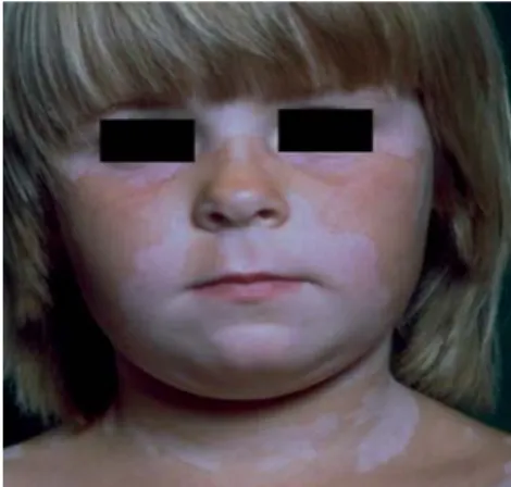 Figura 3 – Vitiligo