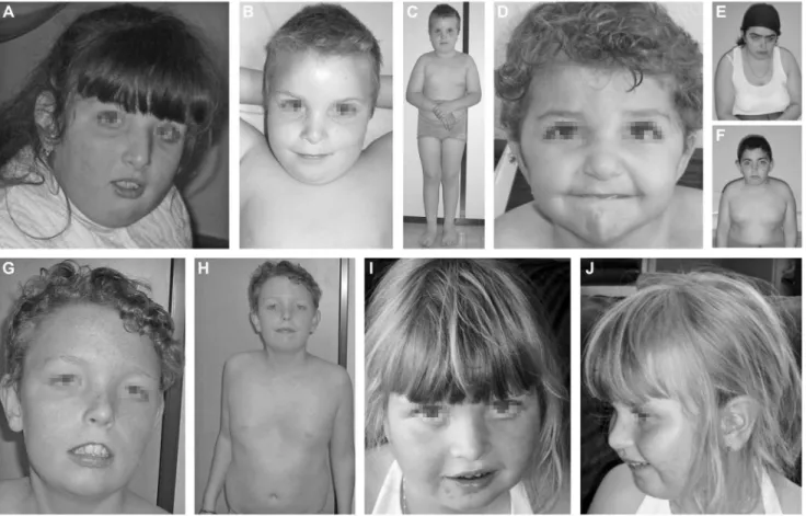 Figure 1. Clinical features of the seven cases. Clinical features of P1 at the age of 7 years (A), P2 at the age of 10 years (B, C), P3 at the age 3.5 years (D), P4.1 at the age of 18 years (E), P4.2 at the age of 12 years (F), P5 at the age of 13 years (G