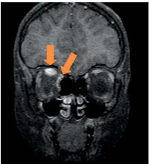 Figura 5 –  RM orbitária (corte frontal – T2): espessamen- espessamen-to do recespessamen-to superior e medial.