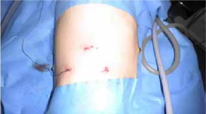 Fig. 1 -  Aspecto final das feridas de inserção dos trocares com o  pormenor do fio para tracção do ureter, em criança de 3 anos de  idade.