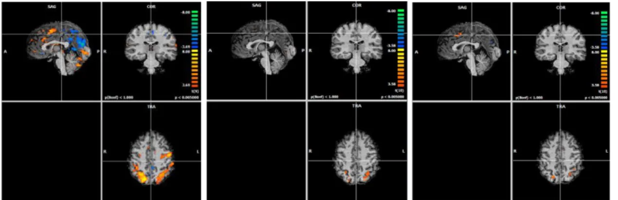 Figura  3.  Mapa  de  ativação  cerebral  (p  &lt;.  005)  no  pré-teste  para  o  GCS  (à  esquerda),  GCE  (ao  centro)  e  GCC  (à  direita)