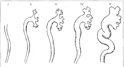 Fig. 1 - Classificação Internacional dos Graus de Refluxo  &lt;17Z&gt; . 1 - Refluxo para o ureter; 