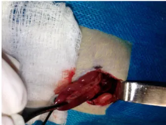 FIGURE 1  -  Markings  (black  dots)  spaced  4  cm  apart  to  indicate  the  location of the right subcostal incision.