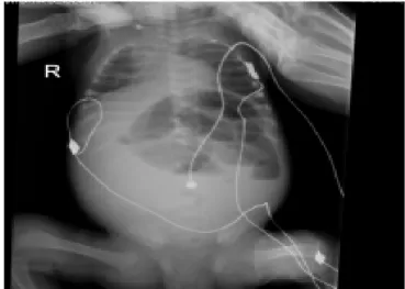 Figura 1 – Radiografia abdominal evidenciando níveis hidro-aéreos e distensão  das ansas intestinais, sem pneumatose intestinal.