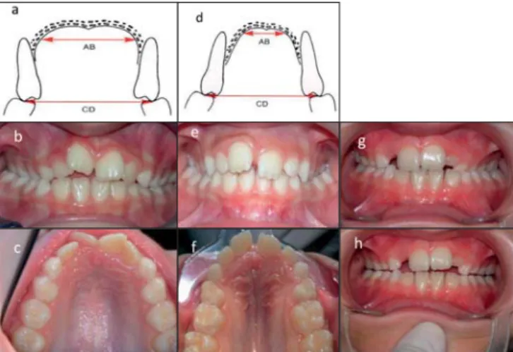 Figura 4 - Mordida em tesoura; a) total unilateral direita; b) individual,  apenas entre os primeiros molares superior e inferior do lado esquerdo