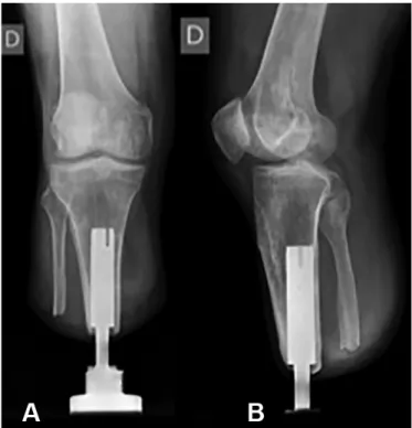 Figura 3. Controlo radiográfico da fase S1 de osteointegração com  implante de titânio intramedular com contacto cortical e empactação  metafisária A)-B).