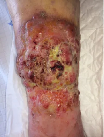 Figure 1. – Initial clinical aspect of the lesions. 