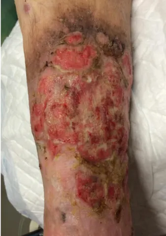 Figure 3. Clinical aspect of the lesions after one cycle of CVP. 