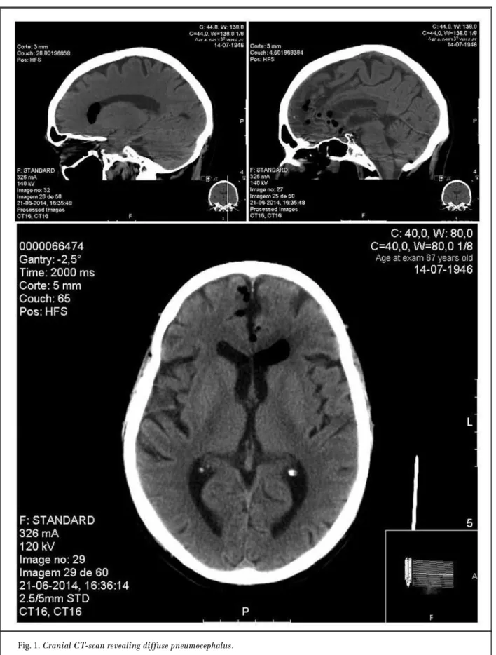 Fig. 1. Cranial CT-scan revealing diffuse pneumocephalus.