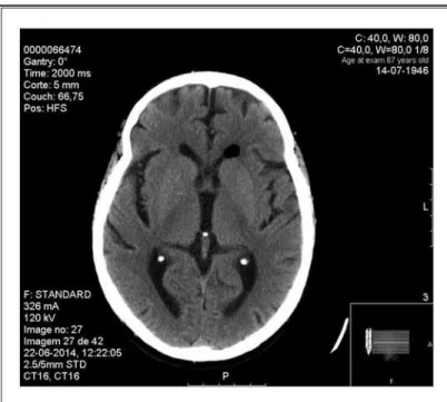Fig. 2.  Cranial CT-scan performed 24 hours after the epidural catheter  placement.