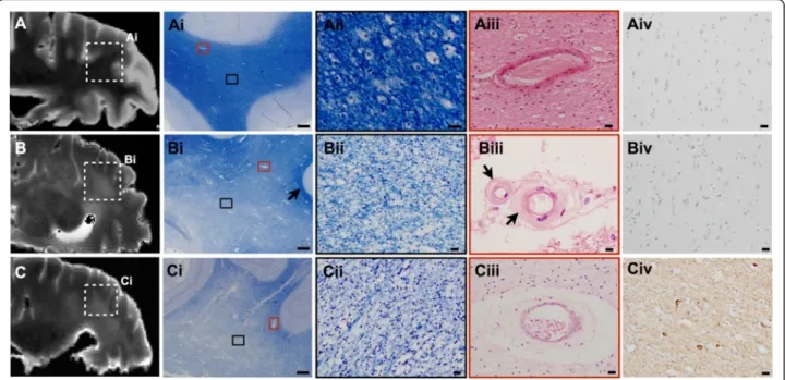 Fig. 2 A series of images for three separate cases indicating normal-appearing white matter and the similarity of white matter changes with differing pathogenesis in the deep white matter of the parietal lobe (Brodman area 39/40), as seen on both T2-weight