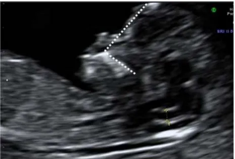 Figura  4  - plano transversal da cabeça fetal num feto normal (A) e com espinha bífida aberta  (B)