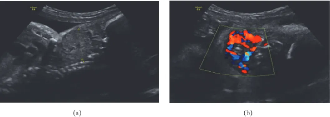 Figure 1: Fetal US by 29 weeks of gestation presenting a vascularized mass in fetal neck.