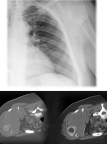 Figura 7: Sarcoma sinovial do ombro esquerdo, imagens de TC e RX.