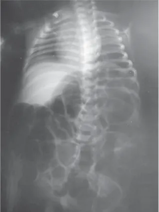 Figura 1 – Rx abdominal simples de pé
