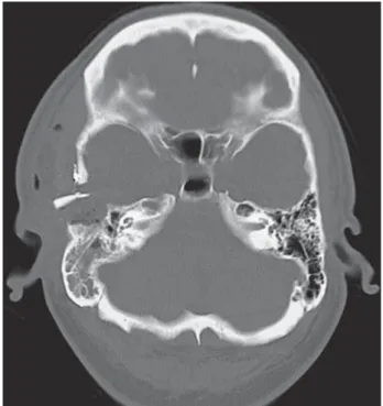 Figure 3  Immediate postoperative axial CT scan in bone algo- algo-rithm reveals a surgical bed with smooth bony margins.