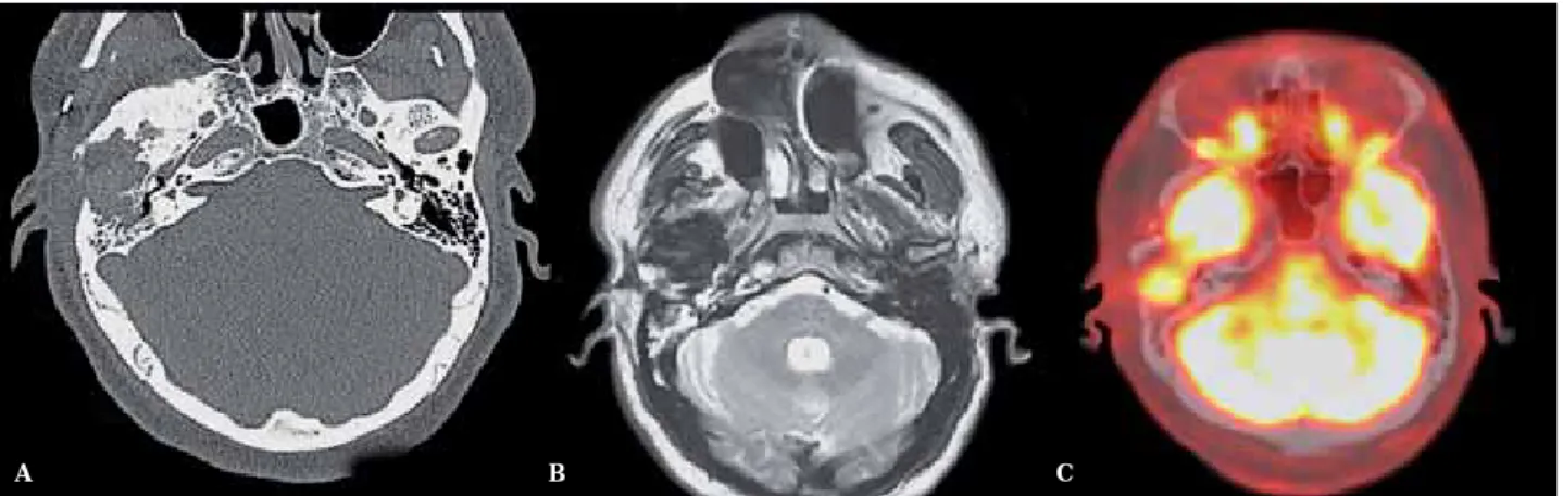 Figure 4  A) Axial CT scan in bone algorithm, of 6 years of follow-up, shows a lytic lesion with irregular, ill-defined bony margins