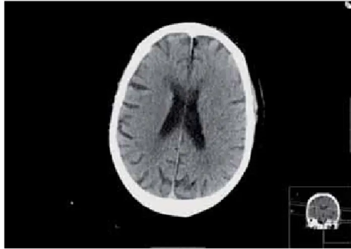 Figure 1  Initial CT-CBV map in a patient with acute left mid- mid-dle cerebral artery occlusion (M1 segment) demonstrates a  fronto-parieto-temporal area of CBV reduction, representing  the ischaemic core.