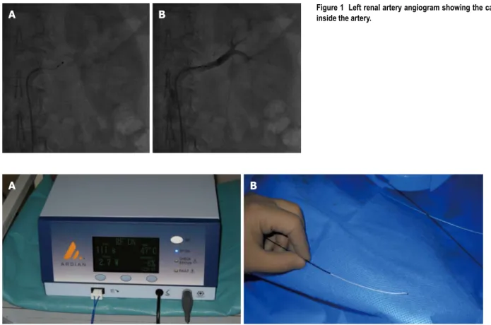 Figure 2  The Symplicity catheter and the radiofrequency console. 