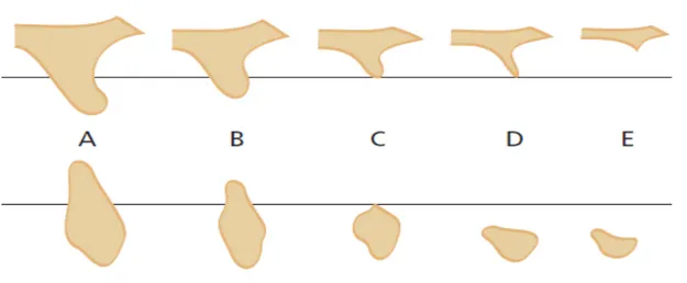 Figura 14 - Classificação sobre a forma de reabsorção da maxila e mandíbula Lekholm  and Zarb 1985 (24) 
