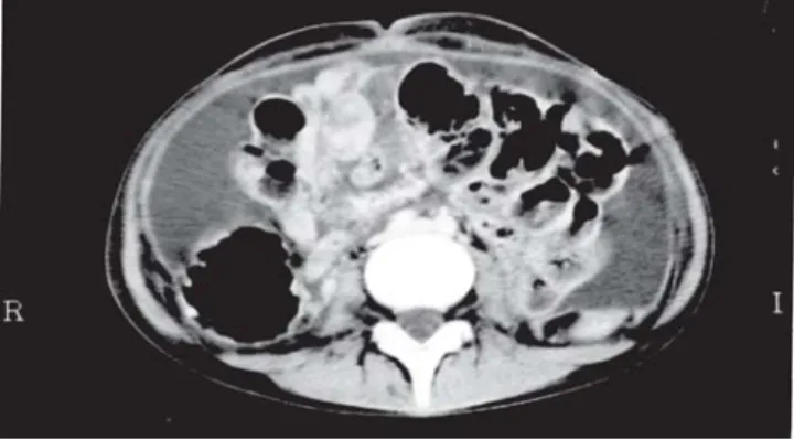 Figure 1 — Abdominal computed tomography image at time of diagnosis of sclerosing encapsulating peritonitis, showing adherent bowel loops, with posterior tethering and lumenal narrowing, peritoneal thickening, and loculated fluid.