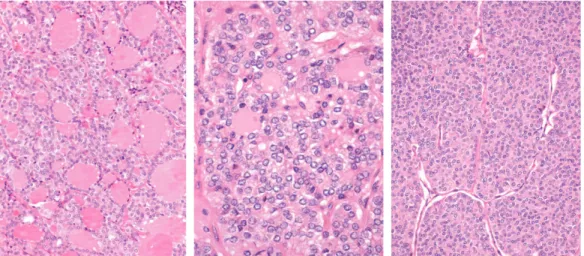 Figure 1: Fragments of bone tissue involved by epithelial neoplasia of follicular architecture, with foci of nondifferentiated (insular) carcinoma [Case 1].