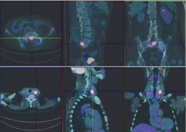 Figure 3: 18F-FDG-PET showing uptake of the radiopharmaceutical drug in thyroid left lobe, L5 vertebrae, and pelvic bones [Case 1].
