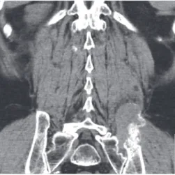 Figure 6: Pelvic CT revealing a 9 cm lytic lesion of left iliac bone [Case 2].