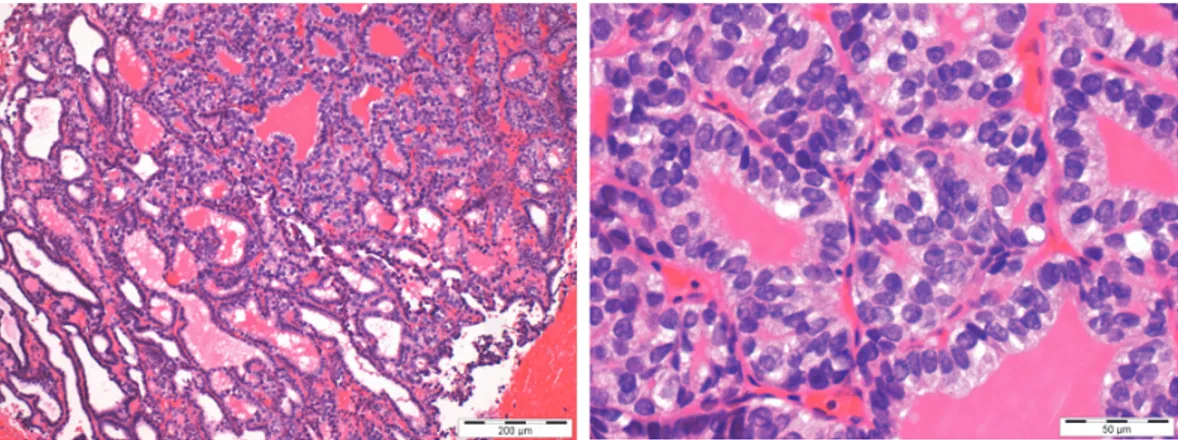Figure 7: Fragments of bone tissue involved by epithelial neoplasia of follicular architecture [Case 2].