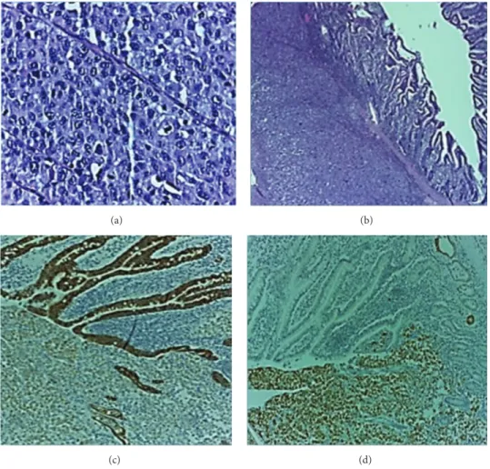 Figure 2: Histologic and IHC study: (a) and (b) indifferenciated carcinoma (hematoxylin and eosin stain) and (c) and (d) positivity for CAM 5.2 and cytokeratin 7.