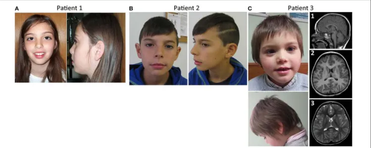 FIGURE 1 | Facial features and brain imaging of the patients. (A) Patient 1 facial features, (B) patient 2 facial features, (C) Patient 3 facial features, and MRI brain imaging.