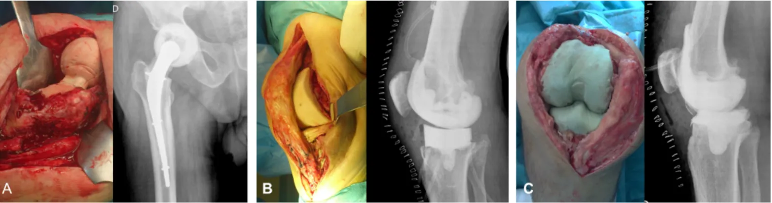 Figura 1: Aspeto clínico e radiográfico dos diferentes espaçadores utilizados: A) espaçador articulado da anca com reforço metálico central  fabricado com o auxílio de moldes de silicone; B) espaçador articulado do joelho fabricado com o auxílio de moldes 
