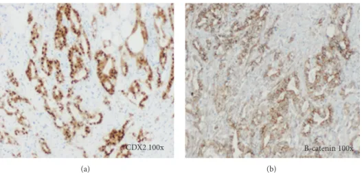 Figure 5: Immunostains: (a) CDX2 positive staining in the tumor; (b) 