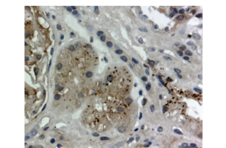 Figure 1: Anti-TTR fixation showed droplets accumulation in the renal proximal  tubular cells, ATTR V30M-amyloidosis, immunoperoxidase technique, original  magnification x400.