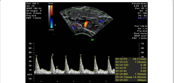 Figure 1 Doppler spectra of uterine artery flow. Pulsatility index (PI) is used as a measure of impedance of the flow of blood distal to the sampling point and is automatically calculated according to the formula PI ¼ ð means−dÞ where s is the peak d is th